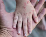 Mano de niño con erupciones rojas, síntoma de sarampión en niños, descansando sobre la mano de un adulto.