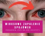 Czerwone, podrażnione oczy z widocznymi naczynkami. Tekst informuje o wirusowym zapaleniu spojówek i poradniku leczenia.