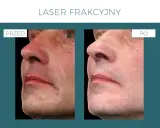 Laser frakcyjny: Skutki uboczne? Co jest normą, a co alarmem?
