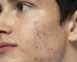 Primo piano del volto di un giovane con piercing al naso, che mostra le imperfezioni della pelle come brufoli e macchie.
