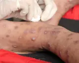 Mani guantate applicano un trattamento su una gamba affetta da scabbia. La temperatura ideale per uccidere la scabbia è di 50°C.