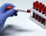 Ręka w niebieskiej rękawiczce trzyma probówkę z krwią do badania Beta hCG – test ciążowy z krwi. W tle stojak z innymi próbkami.