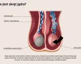 Ilustracja pokazuje skręt jądra, stanowiący przyczynę silnego bólu jądra, gdzie powrózek nasienny ulega skręceniu, blokując dopływ krwi.