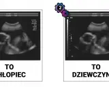 Jak rozpoznać płeć dziecka na USG? Kiedy i na co patrzy lekarz?
