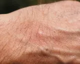 Pelle secca e arrossata con peli sottili, possibile prurito senile. Il trattamento per la xerosi cutanea è fondamentale.