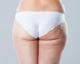 Vue arrière d'une femme en culotte blanche, montrant la cellulite sur sa cuisse.