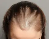 Chevelure clairsemée, signe possible de perte de cheveux carence. Le cuir chevelu est visible par endroits.