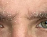 Gros plan sur un sourcil qui gratte et pèle, avec des squames blanches visibles sur la peau et entre les poils.