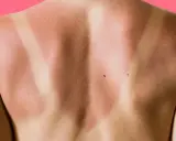 Schiena con evidente abbronzatura a strisce, segno di una giornata al sole con indumenti che hanno lasciato la pelle scoperta in alcune zone.