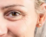 Gros plan sur un œil marron, avec des rides marquées. Une cuillère froide sur les yeux pour soulager les cernes.