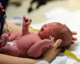 Neugeborenes Baby schreit, die Kopfform ist gut sichtbar. Ein Maßband liegt um den Kopf, wie nach einer Geburt mit Saugglocke.
