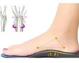 Un pied avec une semelle orthopédique, montrant le soutien. Le podologue utilise ces semelles pour corriger la posture.