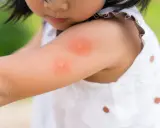 Enfant avec une piqûre d'insecte sur le bras. Une huile essentielle pourrait soulager la démangeaison.