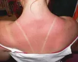 Dos lignes claires sur un dos rouge vif, témoignage d'un coup de soleil. Pour savoir comment faire dérougir un coup de soleil, il faut hydrater et apaiser la peau.