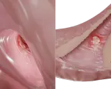 Representación de una llaga o chancro, síntoma temprano de la sífilis en mujeres.