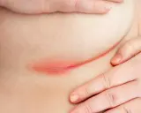 Irritazione cutanea sotto il seno, con rossore e possibile puzza dovuta all'umidità e al calore.