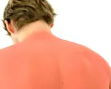 Schiena arrossata dal sole, un ricordo di una giornata intensa. Forse un po' di cefixoral per alleviare il bruciore.