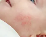 Un petit bouton rouge sur la joue d'un nourrisson, signe d'une peau sensible.