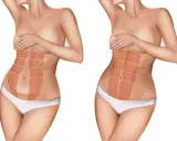 Vergleich zweier Bäuche: links ein Bauch nach Schwangerschaft mit deutlicher Trennung der Bauchmuskeln, rechts ein straffer Bauch mit sichtbaren Muskelpaketen.