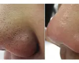 Comparación de nariz antes y después de la extracción de puntos negros. La piel luce más limpia y suave.