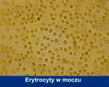 Mikroskopowy obraz moczu z licznymi erytrocytami, niektóre o zmienionym kształcie, sugerujące obecność leukocytów.