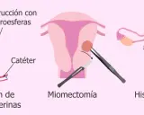 Ilustración de tratamientos para el mioma uterino: embolización, miomectomía y<bos> Histerectomía.