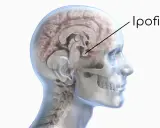 Sezione del cervello umano che evidenzia l'ipofisi. Un tumore ipofisi sintomi può manifestarsi con disturbi visivi o ormonali.