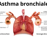 Vergleich gesunder und verengter Bronchien bei Asthma. Symptome wie angespannte Muskulatur und Schleimbildung führen zu Atemnot.