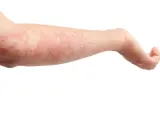 Braccio con eruzione cutanea rossa e pruriginosa, indicativa di orticaria papulosa. Segni a matita sulla pelle.