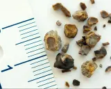 Kawałki kamieni nerkowych, w tym największy kamień nerkowy, obok linijki z oznaczeniem 1 cm.