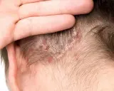Main d'une personne touchant son cuir chevelu, révélant des plaques rouges et des squames cheveux.