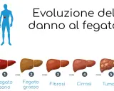 Illustrazione mostra l'evoluzione del danno al fegato: da sano a grasso, fibrosi, cirrosi e tumore.