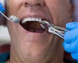 Ból po wyrwaniu zęba: ile trwa, co normą i kiedy do dentysty?