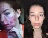 Przed i po kuracji Accutane: skóra z ciężkim trądzikiem i bliznami przechodzi transformację w czystą cerę.