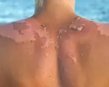Piel descascarada por quemadura solar. Descubre cómo detener el peeling tras la insolación y aliviar tu piel.