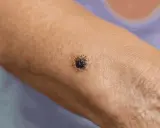 Zbliżenie na ciemną, nieregularną zmianę skórną na ramieniu.