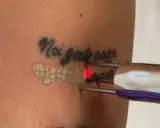 Rimozione tatuaggio con laser: un fascio rosso illumina la pelle mentre si procede a togliere il disegno.