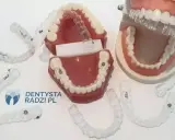 Modele szczęk z widocznymi alignerami. Te przezroczyste nakładki to nowoczesne rozwiązanie do prostowania zębów.