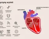 Ilustracja przedstawia przyczyny arytmii serca, od genetyki po styl życia. Czy arytmia serca jest śmiertelna? Zależy od przyczyny i leczenia.