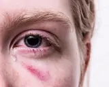 Zaczerwienione oko z łzą spływającą po policzku, gdzie widoczny jest siniak. Widać zaczerwieniony kanalik łzowy.