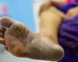 Pied diabétique grade 3 avec une plaie ouverte sur la plante du pied, nécessitant des soins médicaux urgents.