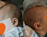 Dwa zdjęcia główki dziecka, pokazujące niezrośnięte ciemiączko u dwulatka. Pomarańczowe kółka zaznaczają obszar ciemiączka.