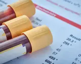 Próbki krwi i wyniki badań, gdzie jeden z parametrów wskazuje na wynik psa powyżej 200.