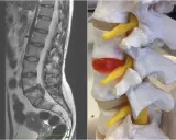 MRI kręgosłupa lędźwiowego obok modelu anatomicznego ukazującego sekwestrację dysku uciskającą nerw.