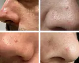 Gros plans sur le nez montrant des rougeurs et des imperfections. Ces images sont utiles pour un diagnostic peau.