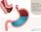 Ilustracja pokazuje żołądek z cofającą się treścią, co jest przyczyną refluksu u niemowlaka. Zielona strzałka wskazuje cofanie się pokarmu.