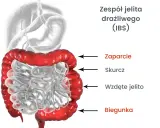 Jelito drażliwe: Objawy, typy, czerwone flagi. Kiedy do lekarza?