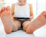 Pies de niño con erupción roja, posible síntoma de rubeola.