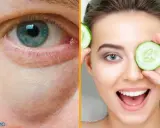 Ojo con bolsas y ojeras, y una mujer sonriente con rodajas de pepino, mostrando remedios caseros para las bolsas en los ojos.