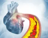 Wysoki cholesterol? Do jakiego lekarza się udać i co dalej?